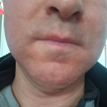 Kiperin Türkiye Kolajen Maskesinin Alerjik Reaksiyonu Ve Trendyol’dan İade Ve Tazminat Talebi