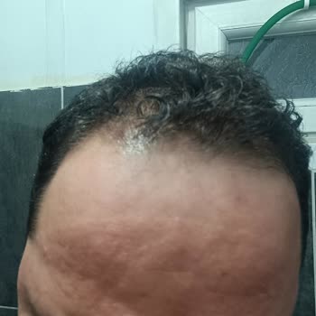 Kiperin Türkiye Kolajen Maskesinin Alerjik Reaksiyonu Ve Trendyol’dan İade Ve Tazminat Talebi