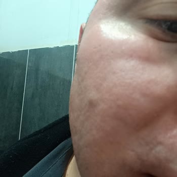 Kiperin Türkiye Kolajen Maskesinin Alerjik Reaksiyonu Ve Trendyol’dan İade Ve Tazminat Talebi