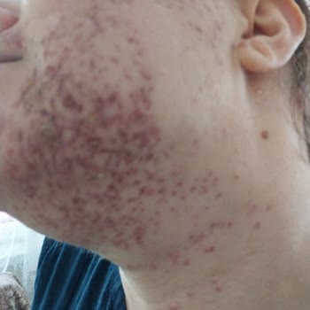 Yanık İzleri Ve Cevapsız Müşteri Hizmeti