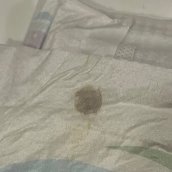 Molfix Bebek Bezinde Siyah Yabancı Madde Ve Sağlık Endişesi