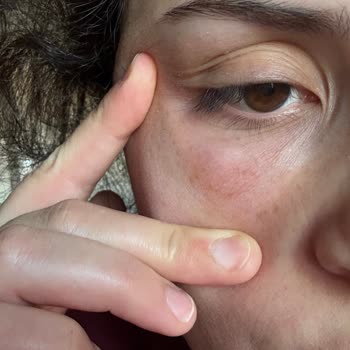 Dermaluxe Ankara İşlem Sonrasında Göz Altlarımda Şişlik, Ağrı Ve Geçmeyen Morluklar Olması