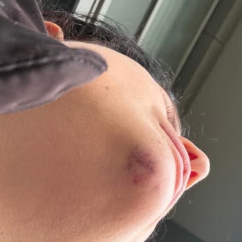 Dermaluxe Ankara İşlem Sonrasında Göz Altlarımda Şişlik, Ağrı Ve Geçmeyen Morluklar Olması