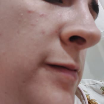 Flormar Perfect Coverage Fondöteni Cildimde Şiddetli Sivilcelenmeye Sebep Oldu