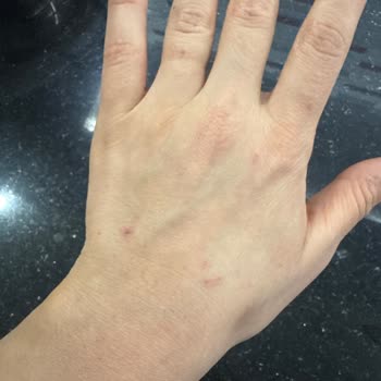 Bingo Sıvı Deterjanı Ellerde Şiddetli Kuruluk Ve Yara: İçerik Analizi Talebi