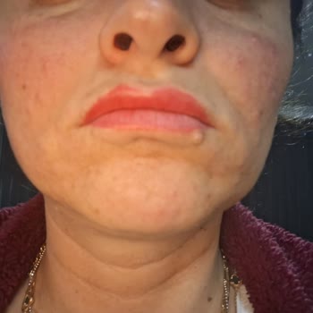 Flormar K‑Spirit Kapatıcıda Şiddetli Alerjik Reaksiyon Ve Geri Ödeme Talebi