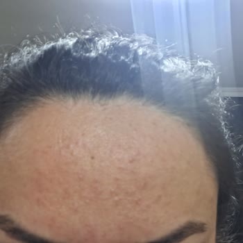 Flormar K‑Spirit Kapatıcıda Şiddetli Alerjik Reaksiyon Ve Geri Ödeme Talebi