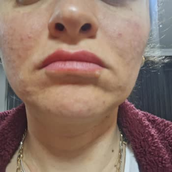 Flormar K‑Spirit Kapatıcıda Şiddetli Alerjik Reaksiyon Ve Geri Ödeme Talebi