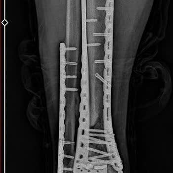 Yüzde 24 Engel Oranı Gerçek Hasarı Yansıtmaz Adil Yeniden Değerlendirme Talebi