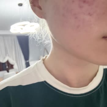 Bioderma Güneş Kremi Yanma Şikayeti Ve İade Reddi