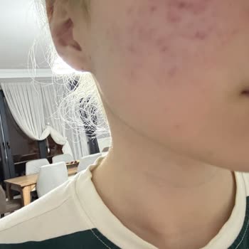 Bioderma Güneş Kremi Yanma Şikayeti Ve İade Reddi