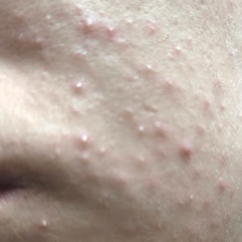 Avene Cicalfate Kremi Ciltte Şiddetli Sivilce Patlamasına Neden Oldu