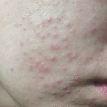 Avene Cicalfate Kremi Ciltte Şiddetli Sivilce Patlamasına Neden Oldu