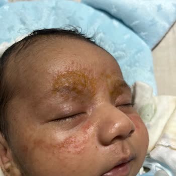 Yenidoğan Bebekte Mustela Şampuanı Şiddetli Konak Ve Şişlik Yarattı