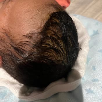 Yenidoğan Bebekte Mustela Şampuanı Şiddetli Konak Ve Şişlik Yarattı