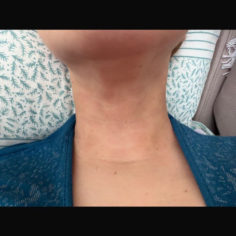 Lazer İşlemi Sonrası Boyun Ve Gıdı Bölgesinde Kalıcı İzler Ve Telafi Talebi