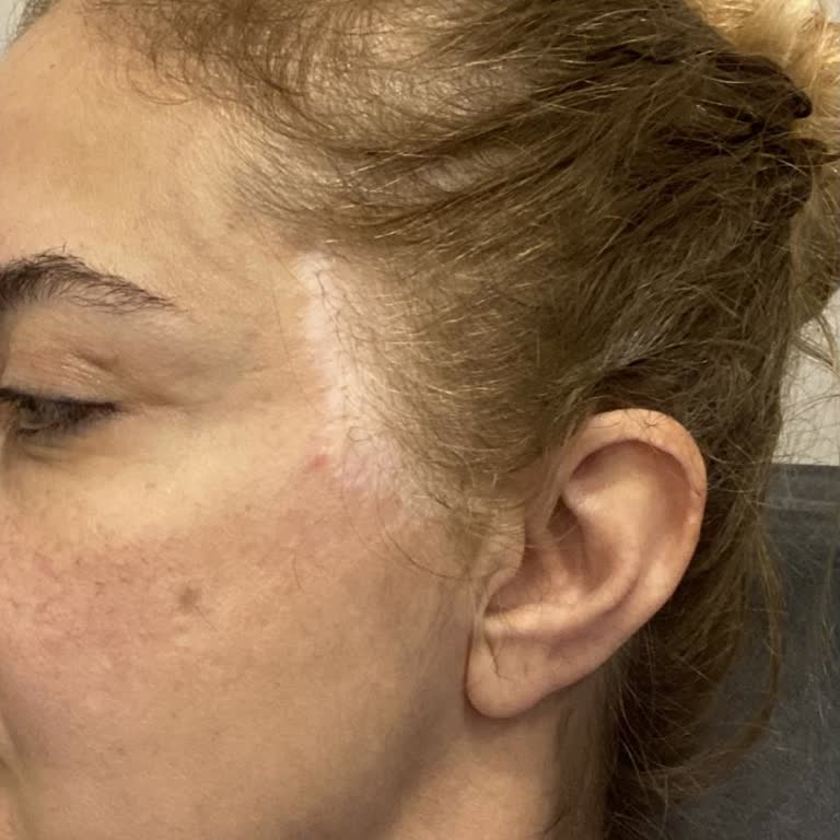 Sym Estetik’te Şakak Germe Sonrası Belirgin Dikiş İzi Ve Yetersiz İletişim