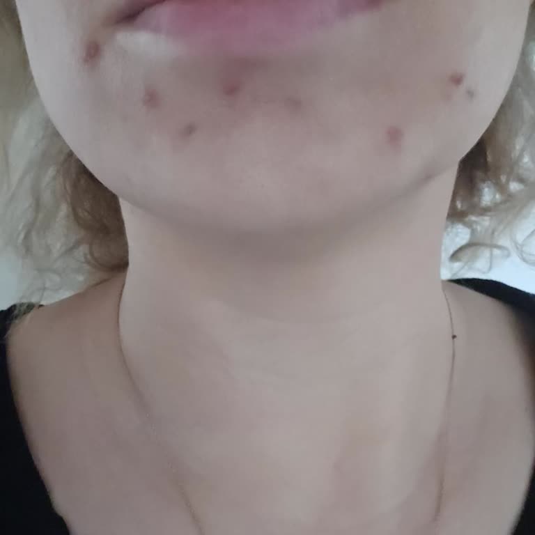 Nova Beauty Center | Tunalı Komedonla Çok Sert Temizlenmeye Çalışıldığı İçin Yara Oldu