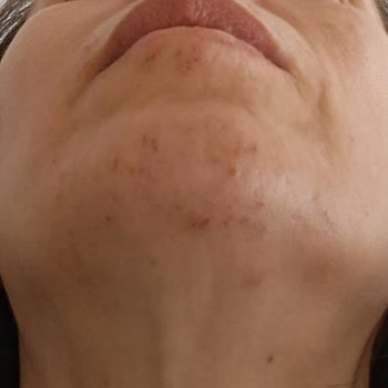 Marilla Güzellik Salonu Yüzüm Hala İyileşmedi