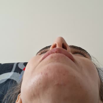 Marilla Güzellik Salonu Yüzüm Hala İyileşmedi