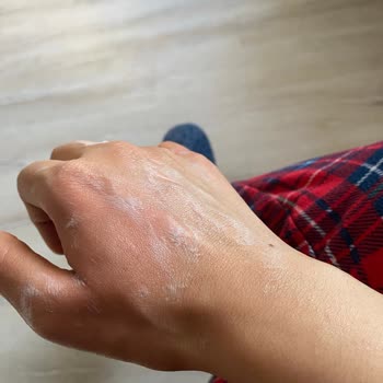 Stanley Termosu Patladı Güvenlik Sorunu Ve Ağır Yanık