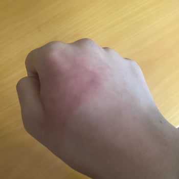 Stanley Termosu Patladı Güvenlik Sorunu Ve Ağır Yanık