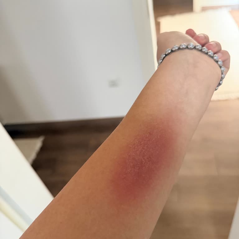 Suit Güzellik Merkezleri Epilasyon Sonrası Ciddi Sorunlar Yaşadım!