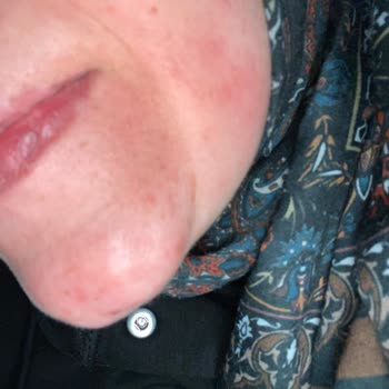 Rossmann Ürününün Ciltte Şiddetli Yanma Ve Uyarı Eksikliği