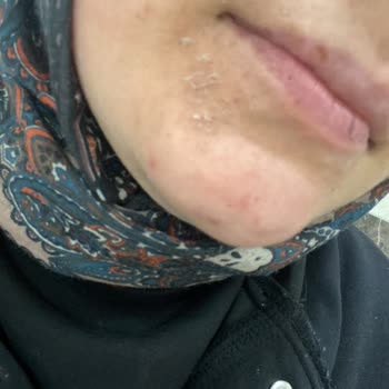 Rossmann Ürününün Ciltte Şiddetli Yanma Ve Uyarı Eksikliği