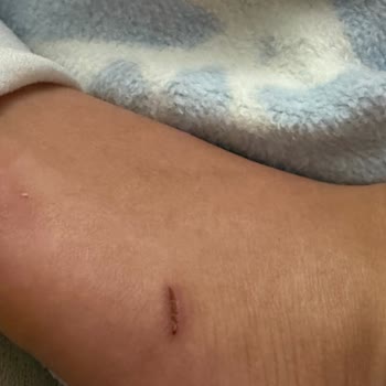 Tencere Kapağının Camı Patladı, Ayak Kesildi Ve Mağduriyetim Giderilmedi