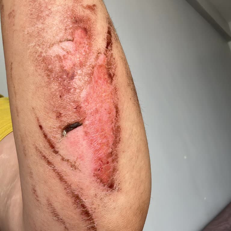 Doa Temizlik Çamaşır Suyunuzdan Dolayı Kimyasal Yanık Oluştu