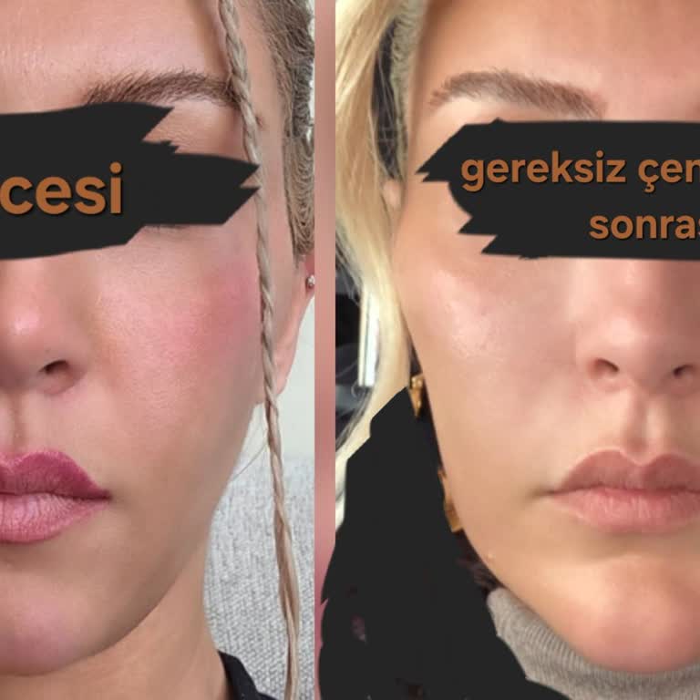 Mikro Gençlik Aşısı İddiası Altında Gereksiz Dolgu İşlemi Ve Masrafların İadesi