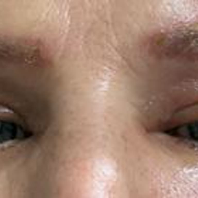 Kaş Silme İşleminde Yanık, İz Ve Şişlik Sorunları Nedeniyle Sözleşme İptali Ve Ücret İadesi Talebi