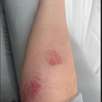 Kaygan Skechers Ayakkabı Eşimi Düşürttü, Sağlık Riski Ve İade Talebi Reddedildi