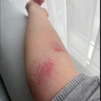 Kaygan Skechers Ayakkabı Eşimi Düşürttü, Sağlık Riski Ve İade Talebi Reddedildi