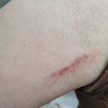 Patlayan Lazer Cihazı Kolumu Yaktı, Güvenlik Ve Sağlık Riski