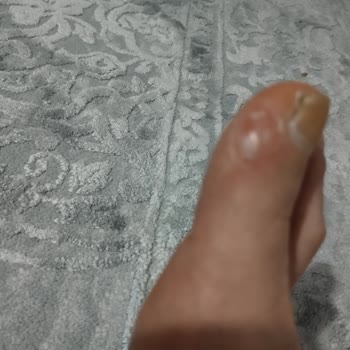 Fazla Ücret Ve Ayak Yaralanmasına Neden Olan Ayıplı Ayakkabı Şikayeti