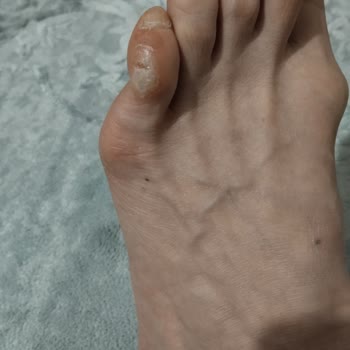 Fazla Ücret Ve Ayak Yaralanmasına Neden Olan Ayıplı Ayakkabı Şikayeti