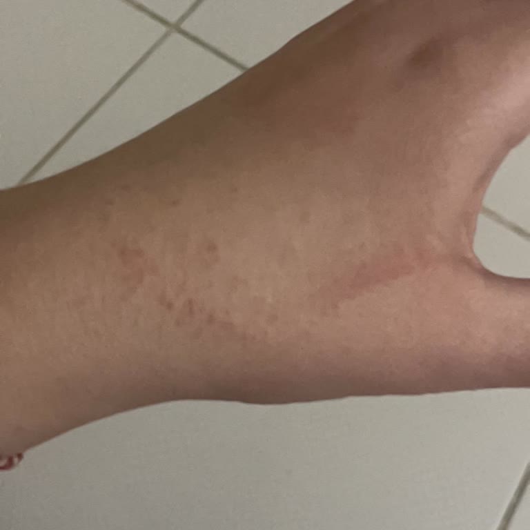 Tester Parfüm Kullanımından Sonra Alerjik Reaksiyon Yaşadım