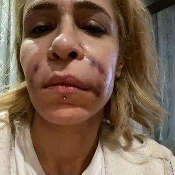 Önceden Ödenen Botoks Ve Kök Hücre İşlemlerinin İhmal Edilmesi Ve Dolgu Sonrası Şiddetli Hasar