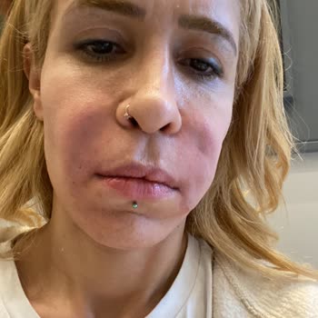 Önceden Ödenen Botoks Ve Kök Hücre İşlemlerinin İhmal Edilmesi Ve Dolgu Sonrası Şiddetli Hasar