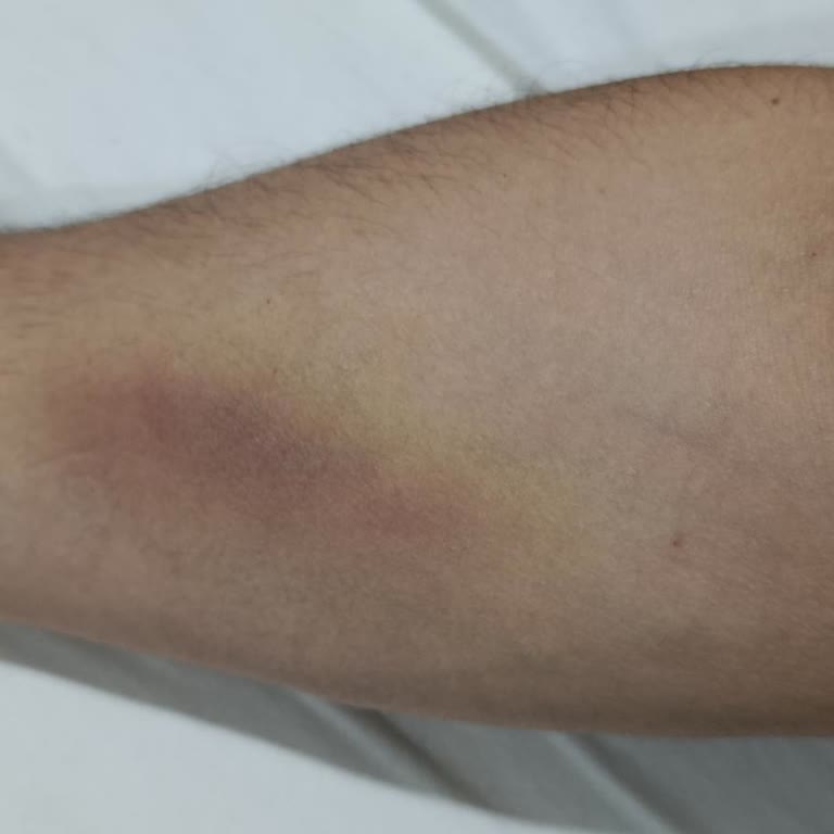 Trombosit Bağışı Sonrası Uzun Süreli Morluk Ve Ağrı İçin Açıklama Talebi