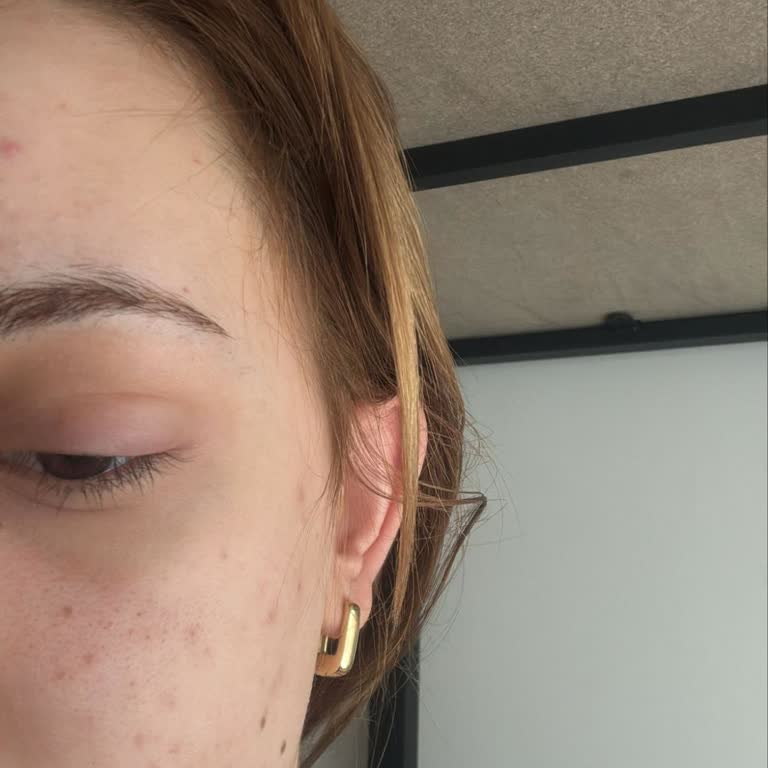 Aymira Koçaklı Yaşam Merkezi İpek Kirpik Uygulamasında Göz Enfeksiyonu Ve Hizmet İhmali