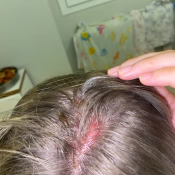 Saç Açma İşleminde Yanık Ve Ciddi Mağduriyet İade Talebi