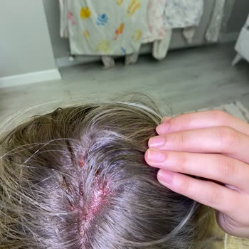 Saç Açma İşleminde Yanık Ve Ciddi Mağduriyet İade Talebi