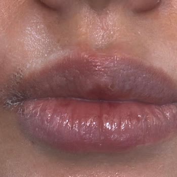 Watsons Yüz Ağda Bandı Kullanımından Şiddetli Yanma Ve Kalıcı İz Şikayeti