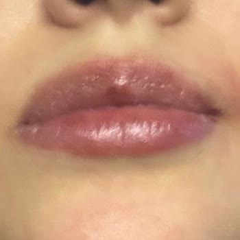 Watsons Yüz Ağda Bandı Kullanımından Şiddetli Yanma Ve Kalıcı İz Şikayeti