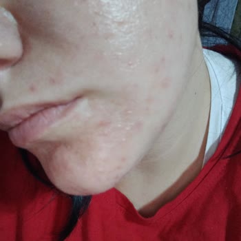 Trendyol’da Aldığım Bioxcin Ürünlerinden Yanık ve Cilt Sorunları