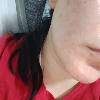 Trendyol’da Aldığım Bioxcin Ürünlerinden Yanık ve Cilt Sorunları