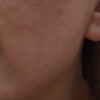 Bbm Estetik Cilt Yanması, Kabuklanma Ve Etkisiz Hydrafacial Sonrası İlgisiz Hizmet